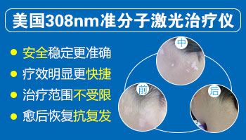 隐形白癜风怎么检查好